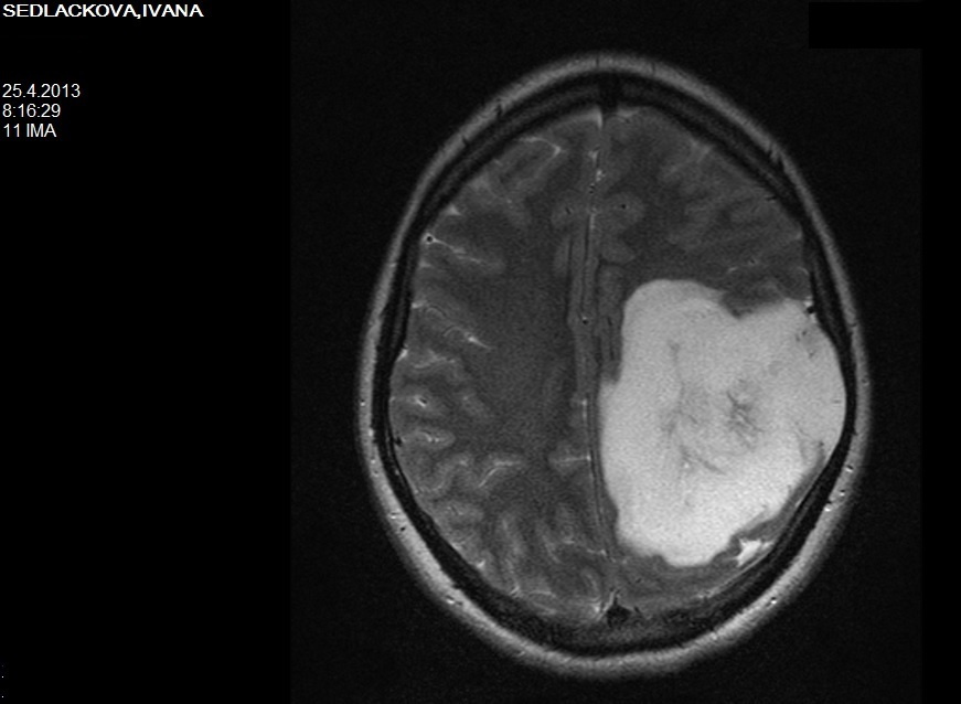Snímek mozku z magnetické rezonance.