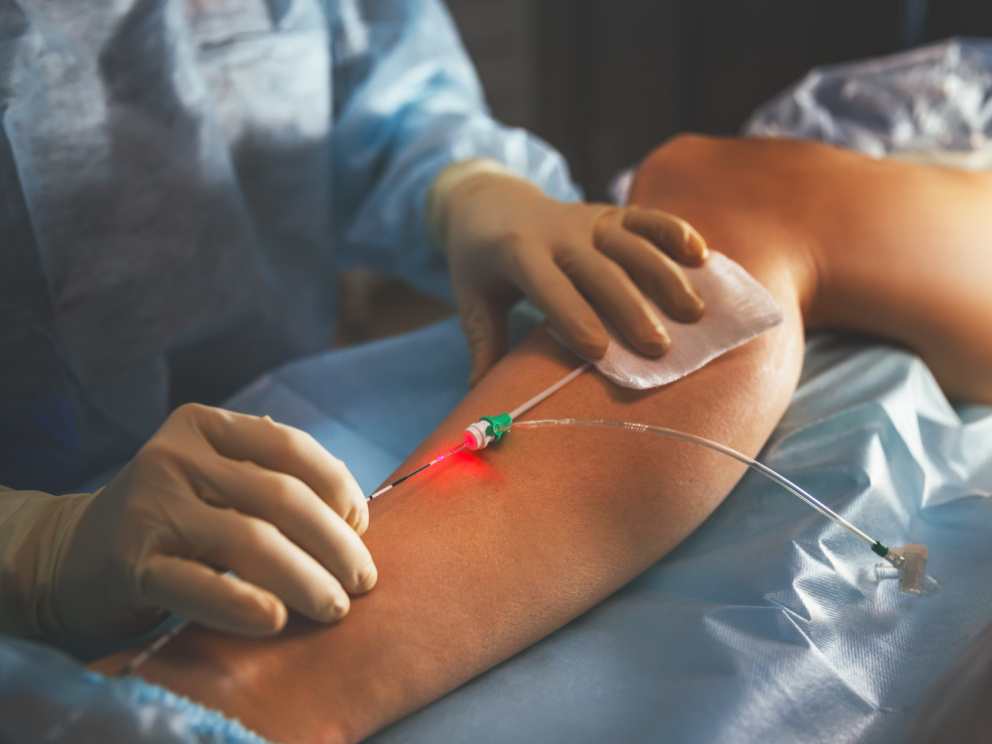 Ošetření cév doprovodnou laserovou diodou