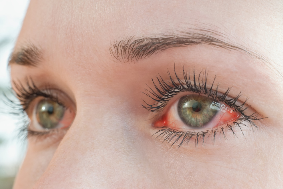 Zarudlé oči mohou být znakem mnoha nemocí