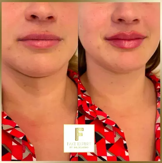 Foto 1 k článku Češky propadly kouzlu zvětšených rtů: Doktorka estetické medicíny, která je jimi proslulá, ovšem nevyhoví každé zákaznici