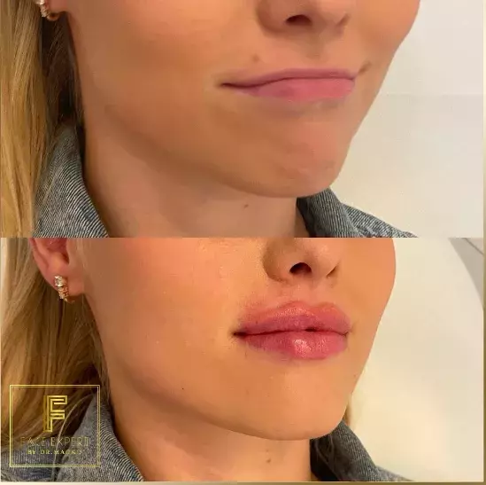 Foto 3 k článku Češky propadly kouzlu zvětšených rtů: Doktorka estetické medicíny, která je jimi proslulá, ovšem nevyhoví každé zákaznici