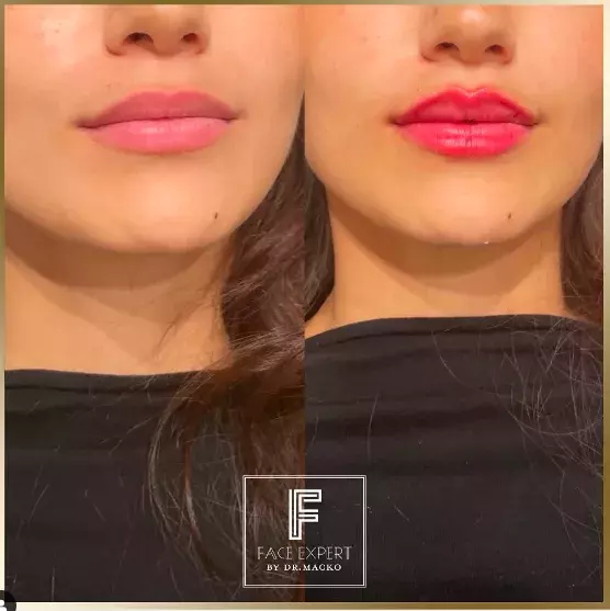 Foto 2 k článku Češky propadly kouzlu zvětšených rtů: Doktorka estetické medicíny, která je jimi proslulá, ovšem nevyhoví každé zákaznici