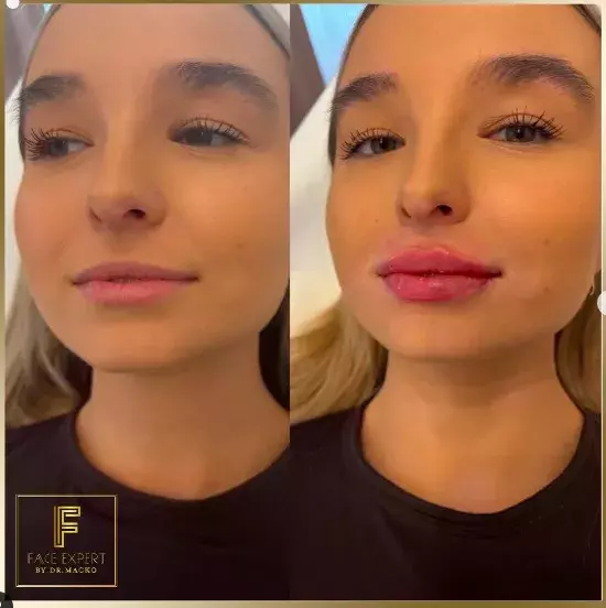 Foto 5 k článku Češky propadly kouzlu zvětšených rtů: Doktorka estetické medicíny, která je jimi proslulá, ovšem nevyhoví každé zákaznici