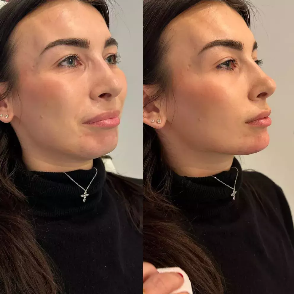 proměna profilu před a po