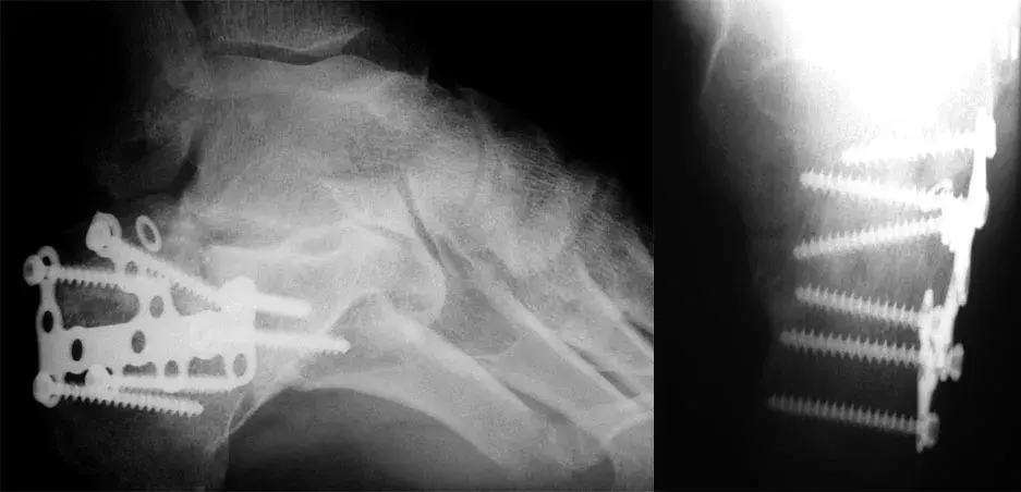 Celé odvětví technologie nese jméno svého objevitele. Rentgenové snímky zlomeniny patní kosti s plátováním.