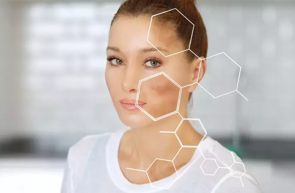 žena s pigmentovými skvrnami