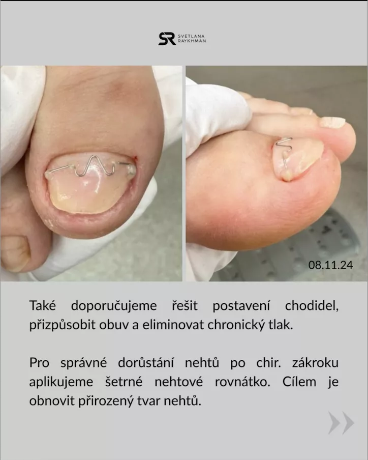 zničené nehty