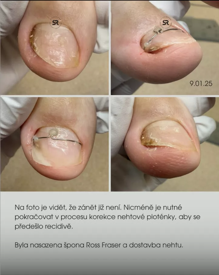 zničené nehty