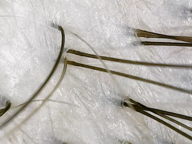 Vlasová pokožka po proceduře Head spa