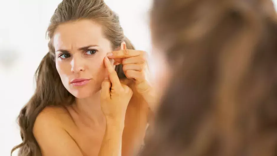 Z akné nevyrostete: Jak nepříjemné pupínky léčit i po čtyřícítce?