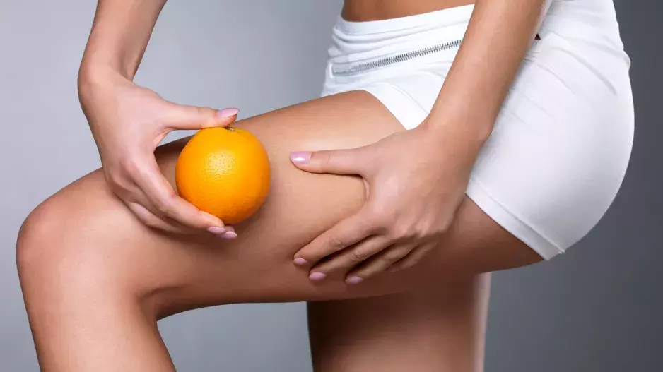 Nenáviděná celulitida: Vyzkoušejte tyto tipy i babské rady a do léta je navždy pryč!