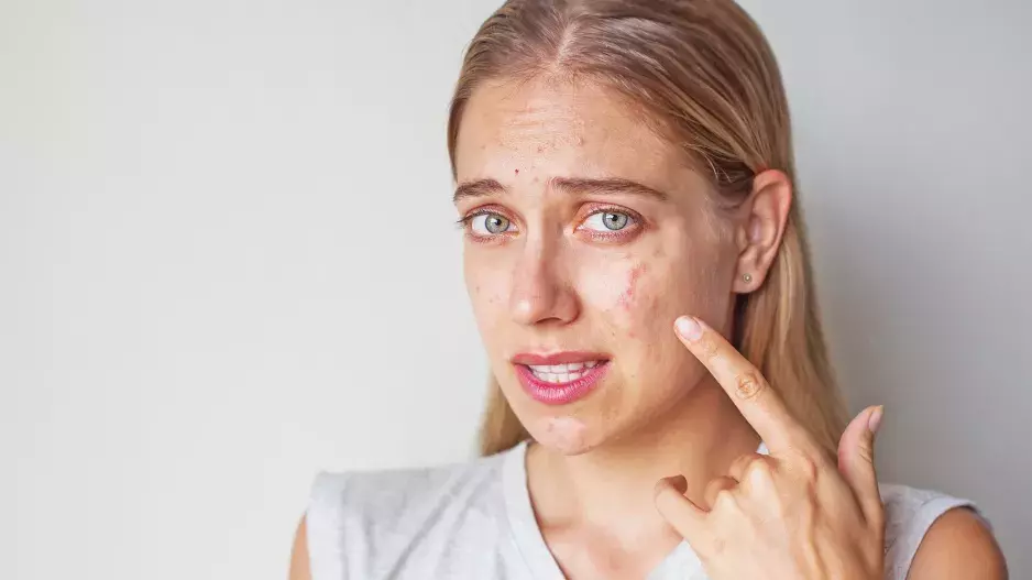 Tyto potraviny škodí vaší pleti: Způsobují její stárnutí, akné i dehydrataci