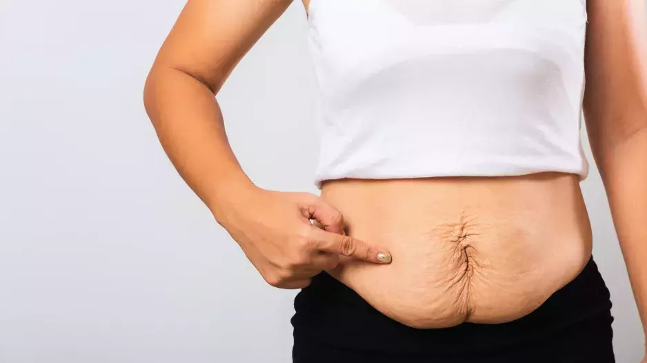 Matka se snaží motivovat ostatní, že strie nejsou tabu: „Píchnutá pneumatika či klokaní kapsa,“ slýchávala na adresu svého břicha