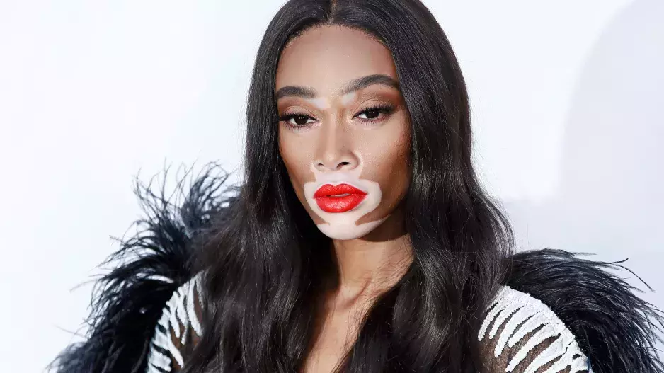 Supermodelka s vitiligem Winnie Harlow: Šikanu vystřídal úspěch a nyní boří stereotypy krásy