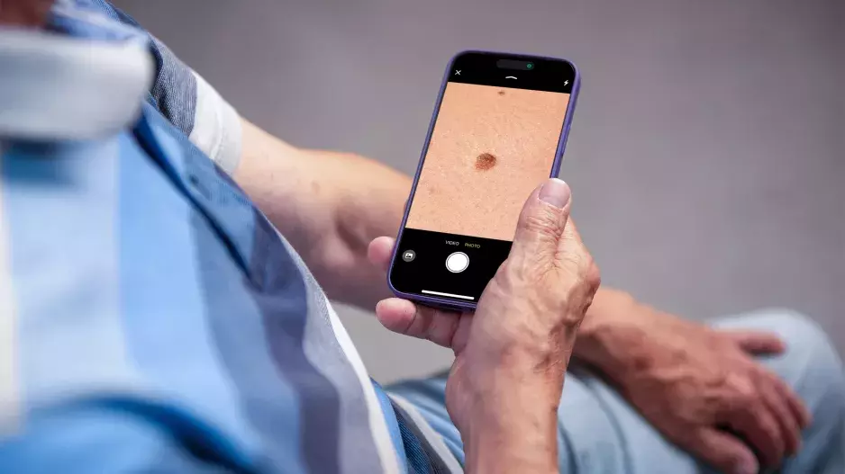 Zhoubné nádory kůže pozná umělá inteligence v chytrém telefonu. Lékaře však nenahradí
