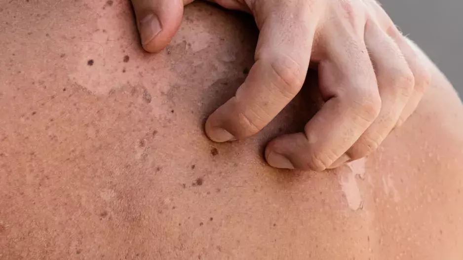 Pochopte rozdíl mezi suchou pokožkou a ekzémem