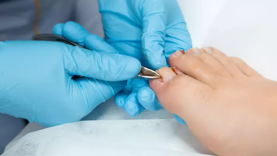 Zarostlý nehet dokáže pěkně potrápit. Příznaky nepřehlížejte, problém se může rychle zhoršit