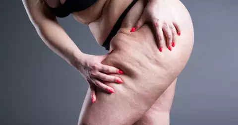 Řadě žen se nedaří zhubnout stehna: Máme pro vás osvědčený návod jak na to, cvičit nestačí!