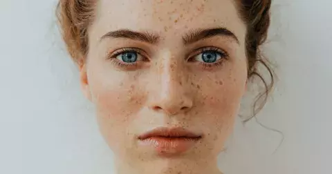 Pihy a pigmentové skvrny přibývají s věkem. Na vaše otázky odpovídá dermatoložka MUDr. Zuzana Kotlasová