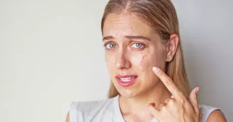 Tyto potraviny škodí vaší pleti: Způsobují její stárnutí, akné i dehydrataci