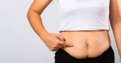 Matka se snaží motivovat ostatní, že strie nejsou tabu: „Píchnutá pneumatika či klokaní kapsa,“ slýchávala na adresu svého břicha