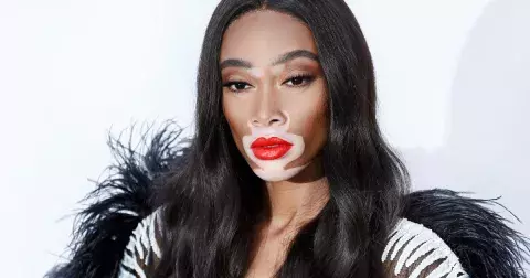 Supermodelka s vitiligem Winnie Harlow: Šikanu vystřídal úspěch a nyní boří stereotypy krásy