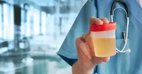 Zdraví: Stav ledvin odhalí barva moči. Spolehlivě vám diagnostikuje cukrovku, infekci i míru hydratace