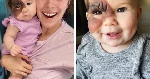 Holčička má na obličeji vzácné mateřské znaménko. Její rodiče čelí nehezkým komentářům na sociálních sítích