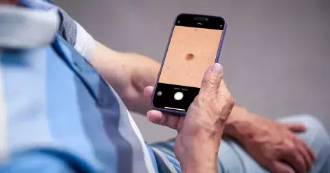 Zhoubné nádory kůže pozná umělá inteligence v chytrém telefonu. Lékaře však nenahradí