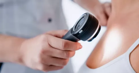 Rakovina kůže: Nemoc pomůže odhalit včas jeden opomíjený příznak. Světlá pleť je nejrizikovější