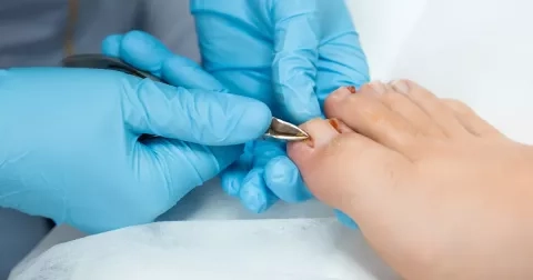 Zarostlý nehet dokáže pěkně potrápit. Příznaky nepřehlížejte, problém se může rychle zhoršit